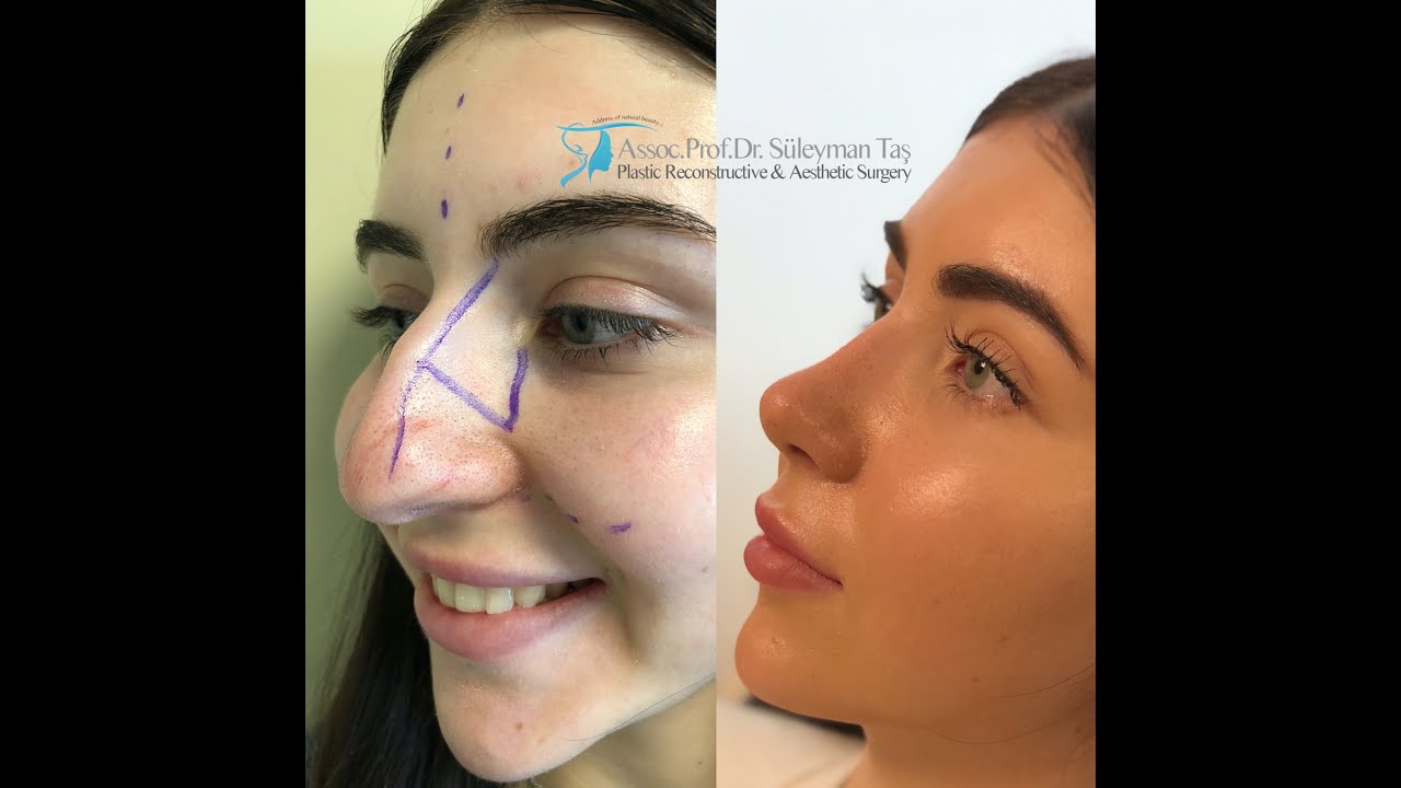The best nose job with before and after