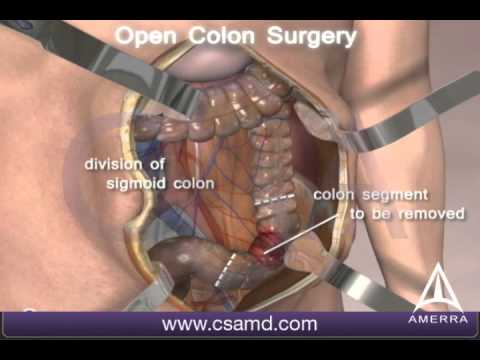 Colorectal cancer surgery - Open procedure - 3D animation