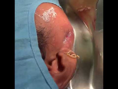 Incision and Drainage of saliva from below the ear region - Parotid sailocoele draining video