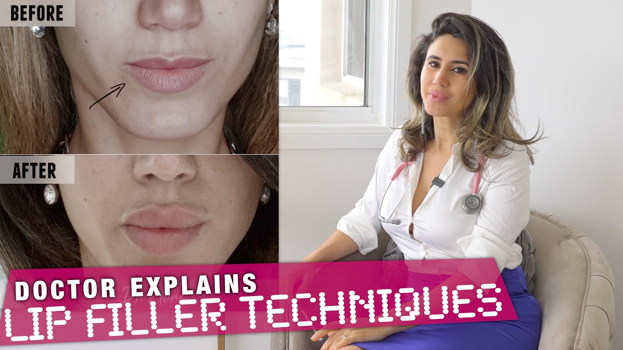 Which Lip Filler Technique? 5 Case Studies for BEST RESULTS | Doctor Explains 