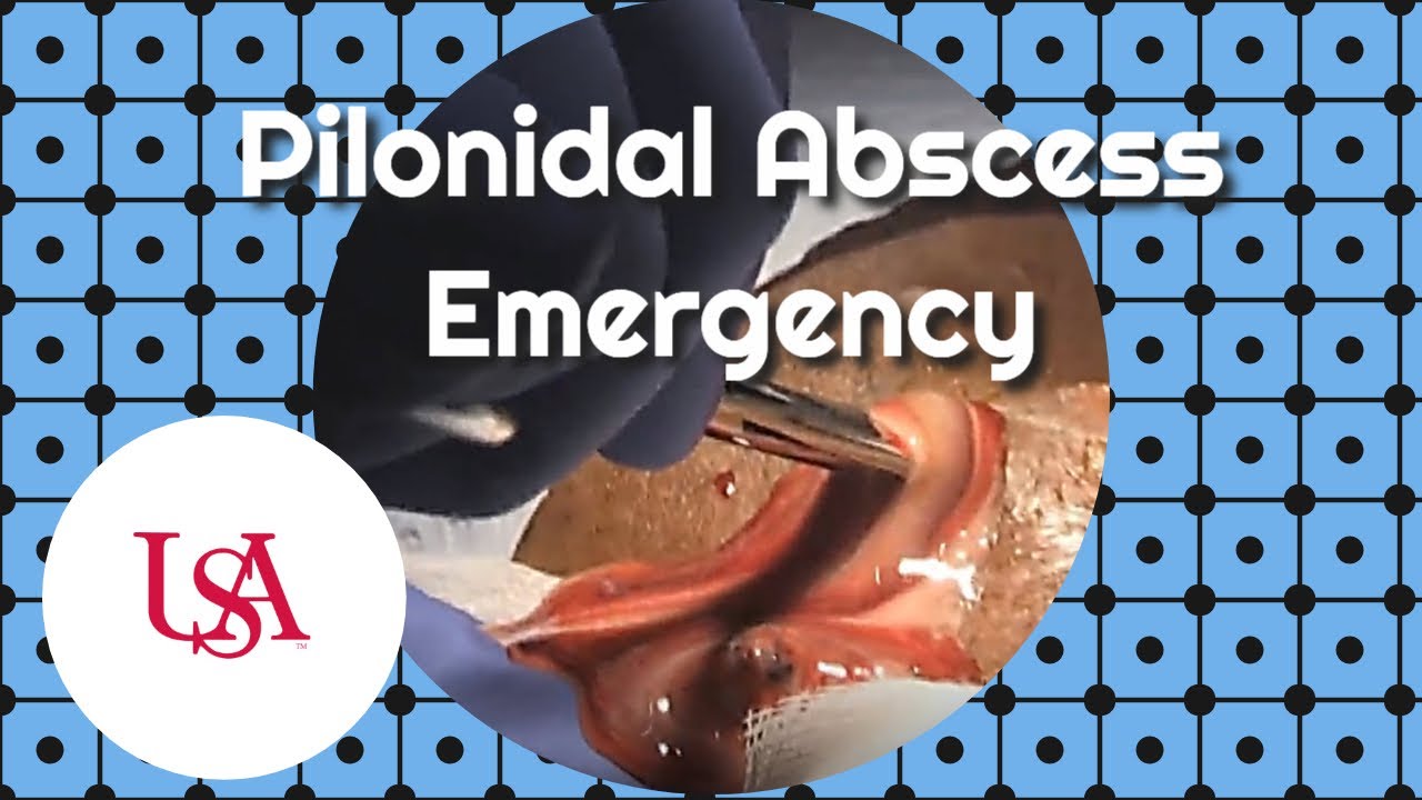 Pilonidal Abscess Emergency Incision & Drainage