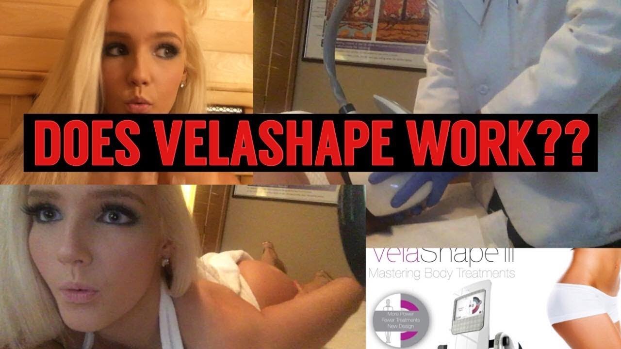 DOES VELASHAPE 3 WORK? (BEFORE AND AFTER )WYMORE MED SPA