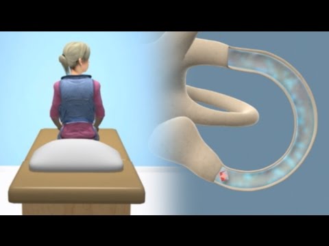 epley-maneuver-to-treat-bppv-vertigo