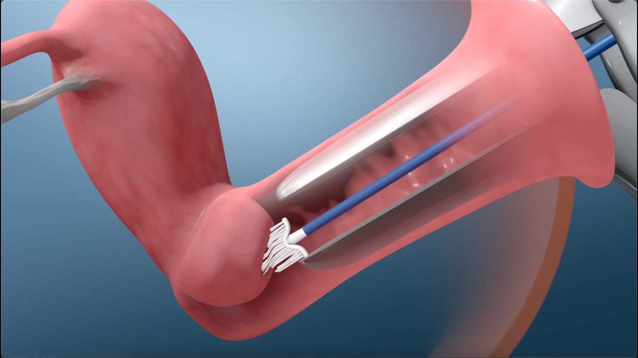 What Happens During a Pap Test 