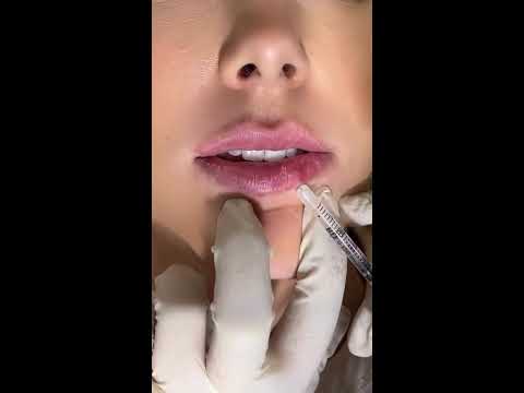 Lip Filler Transformation | Immediate Results In Just Minutes