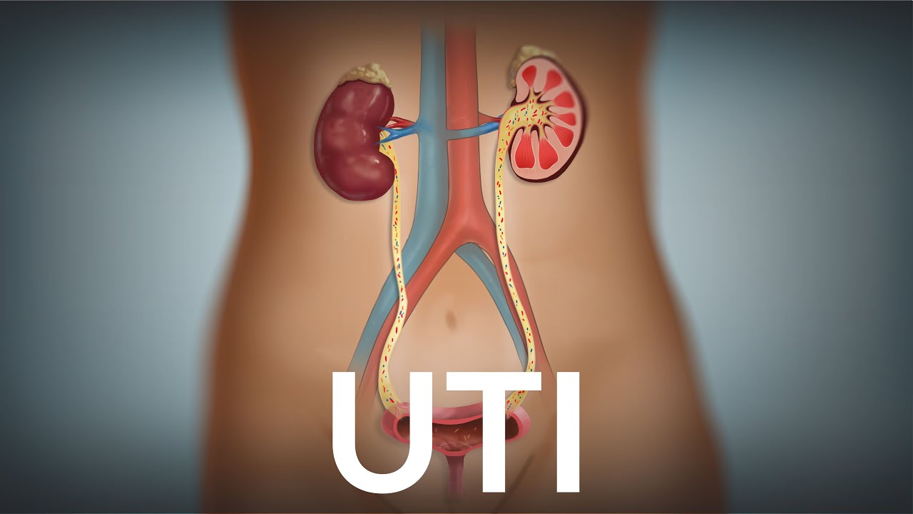 Urinary Tract Infection by E Pingree   OPENPediatrics