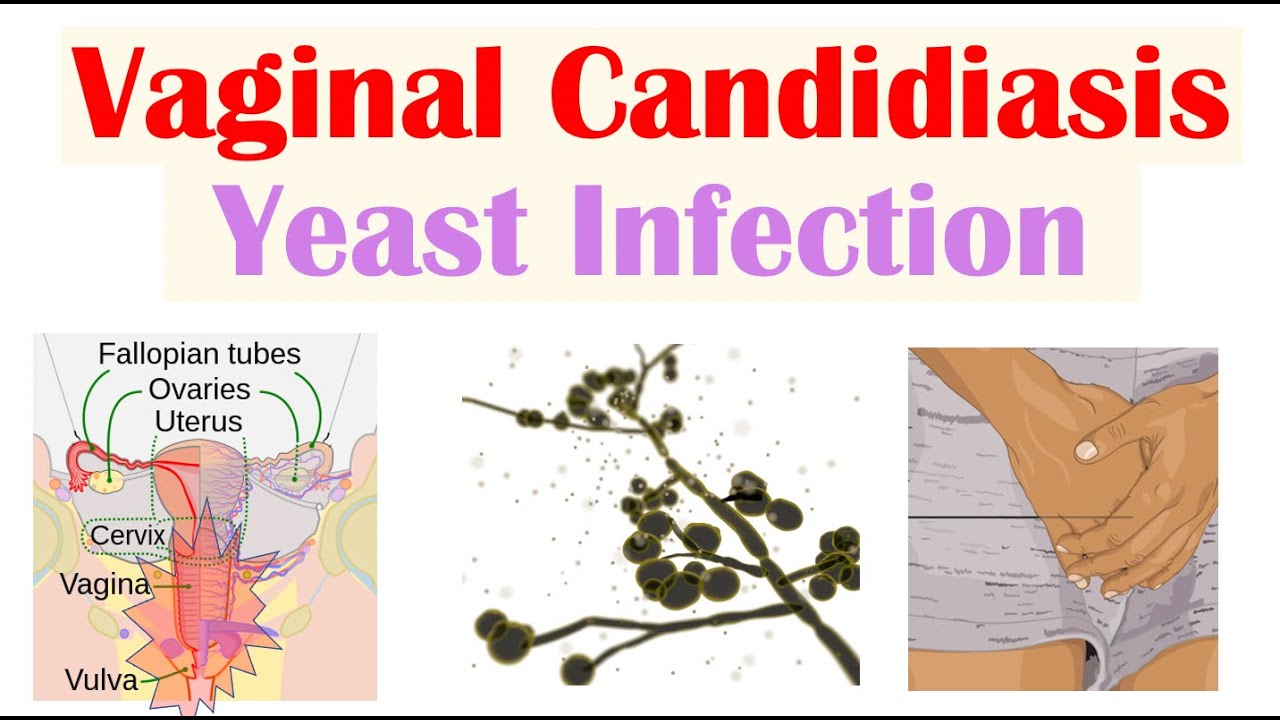 Vaginal Candidiasis ('Yeast Infection”) Causes, Risk Factors, Signs & Symptoms, Diagnosis, Treatment