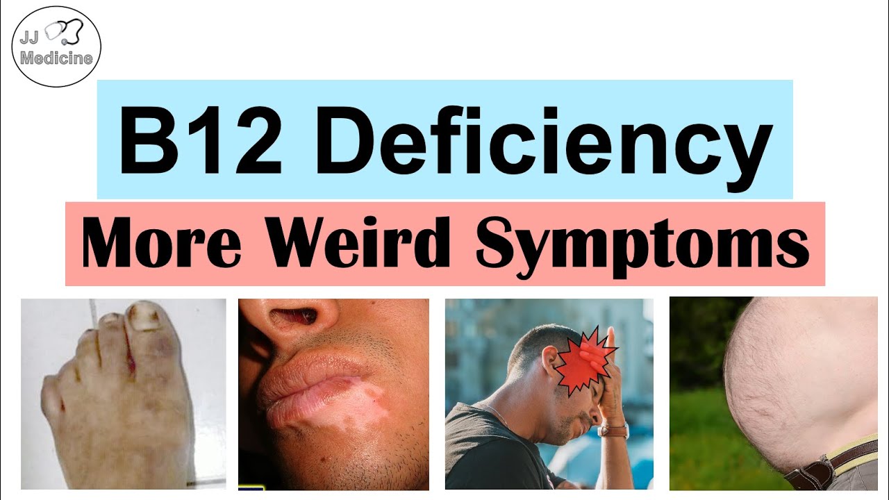 Vitamin B12 Deficiency Weird Symptoms – Part 2 (Types of Headaches, Gastrointestinal and Others)