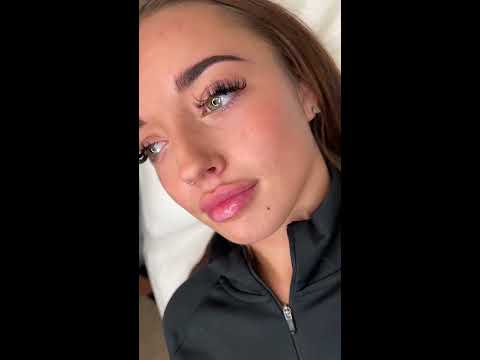 Russian lips before and after #shorts // tiktok chichesteraesthetics
