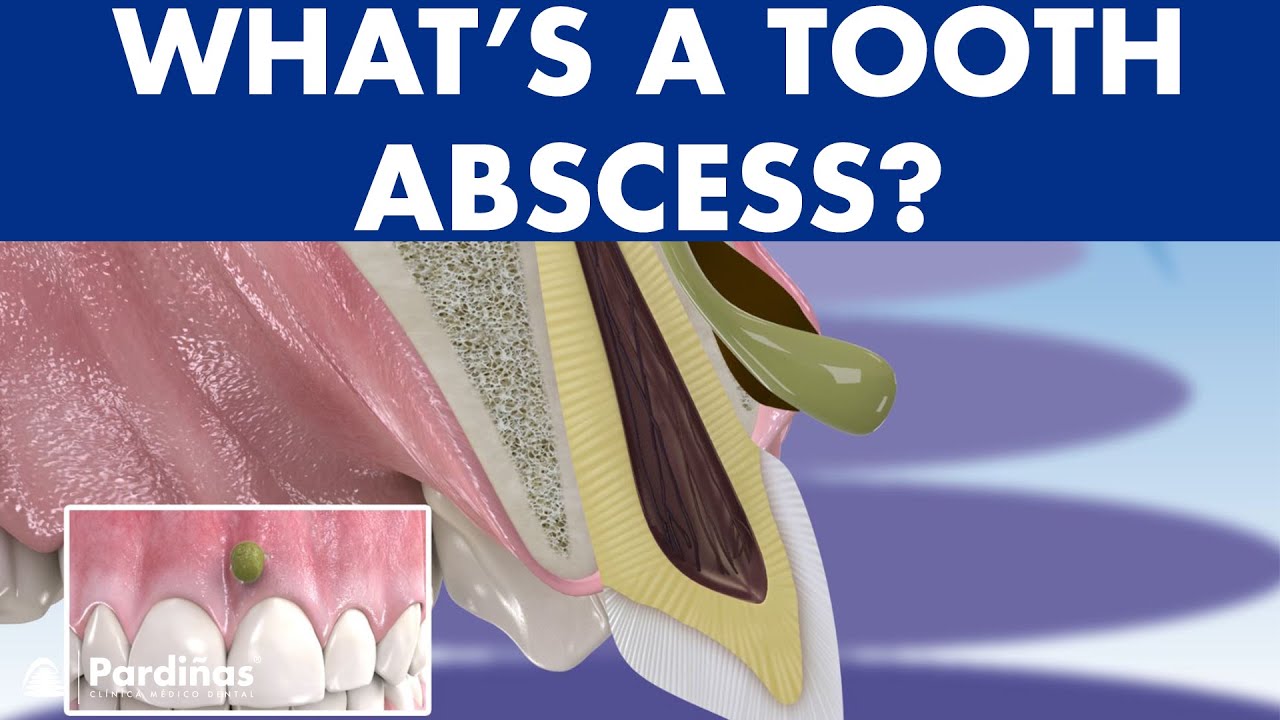 TOOTH ABSCESS DENTAL İNFECTİON - PHLEGMON SYMPTOMS AND TREATMENT ©