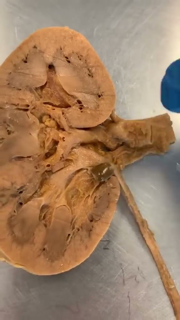 Real Kidney Stone In a Real Kidney