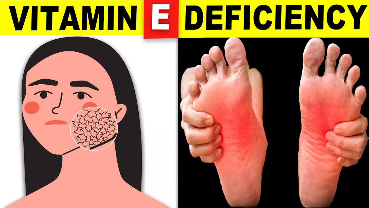 7 Signs Your Body Is Begging for Vitamin E