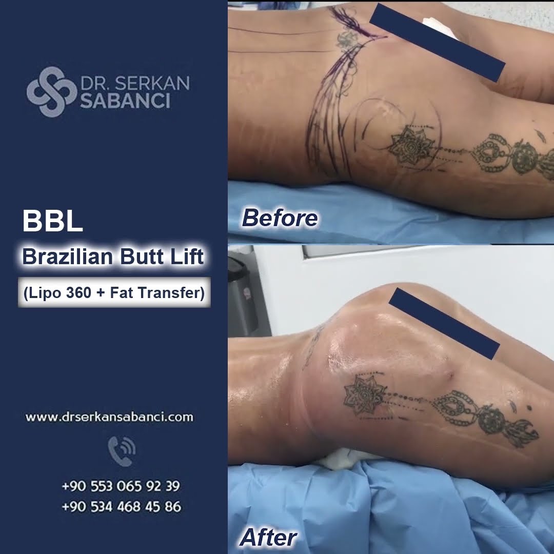 BBL Brazilian Butt Lift |  Op. Dr. Serkan Sabancı | Plastik Rekonstrüktif ve Estetik Cerrahi