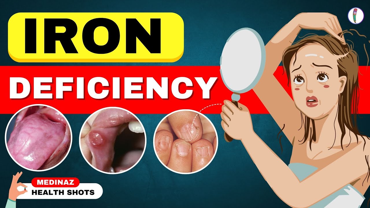  Weird Signs You're Low on Iron   Iron Deficiency Anemia   Iron Deficiency Symptoms