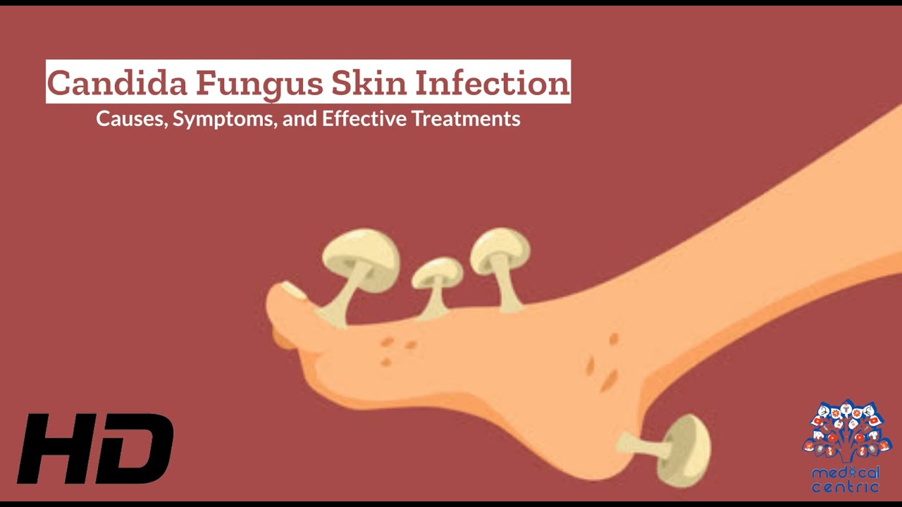 CANDİDA FUNGUS SKİN INFECTİON EXPLAİNED: WHAT YOU NEED TO KNOW