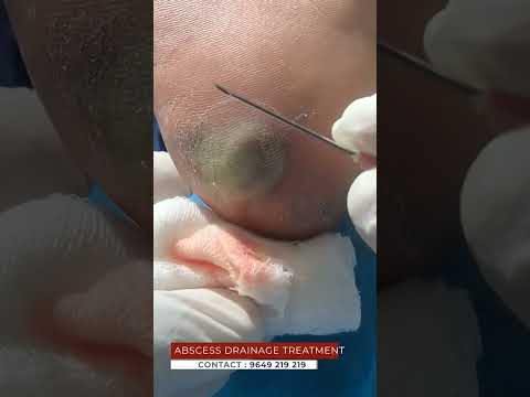 Think Abscess Drainage Treatment Is Too Good to Be True? We Have News for You | viral #shorts