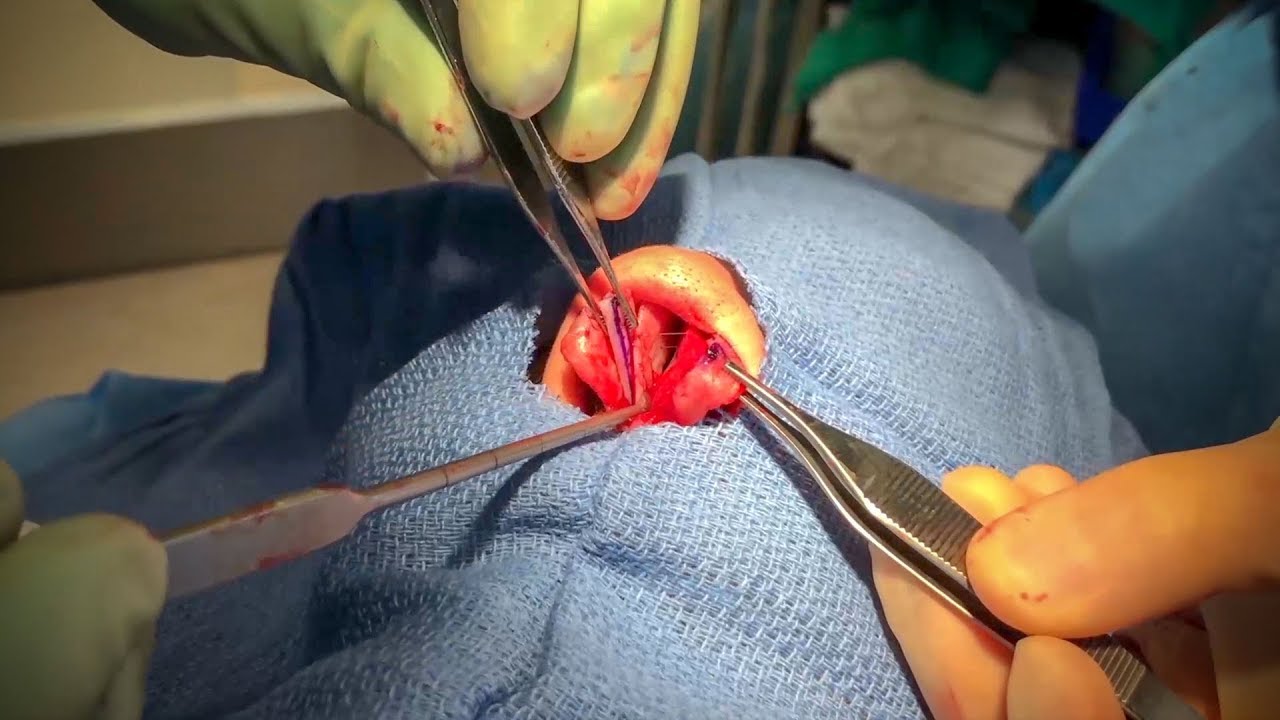 Rhinoplasty: Using the Tongue-in-Groove Technique to Achieve Precise Control of the Tip