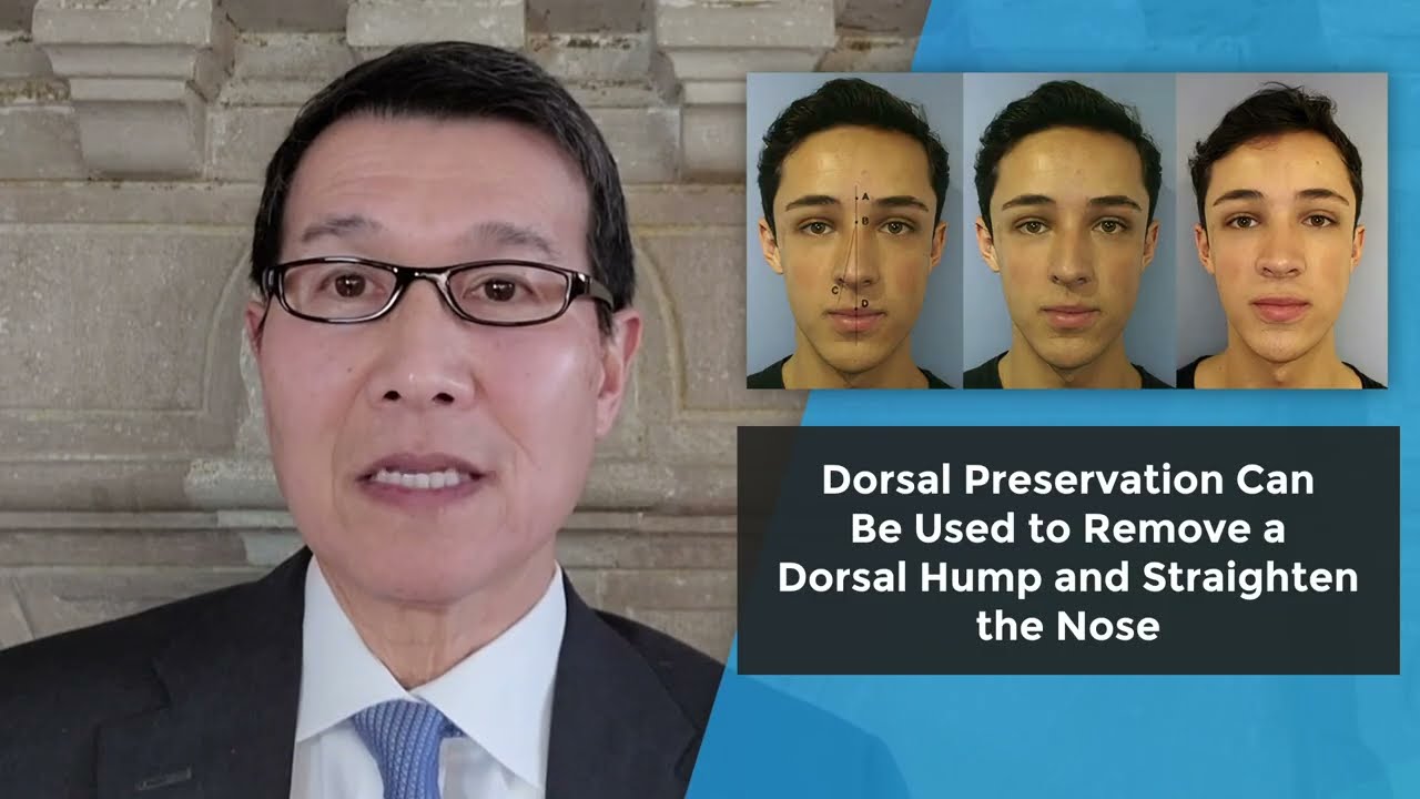 Preservation Rhinoplasty for Twisted Nose by Dean Toriumi, MD