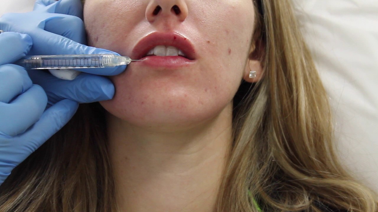 Juvederm lip filler injection by Dr. Shaun Patel in Miami, Florida.