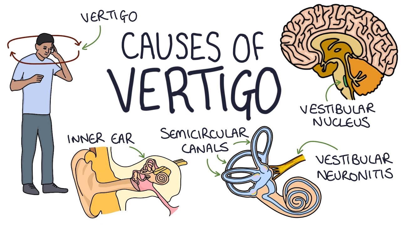 Understanding the Causes of Vertigo