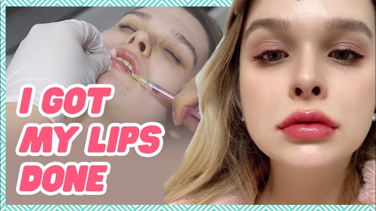Natural Looking and Fuller Lips with Korean Lip Fillers | Step by Step, Before and After