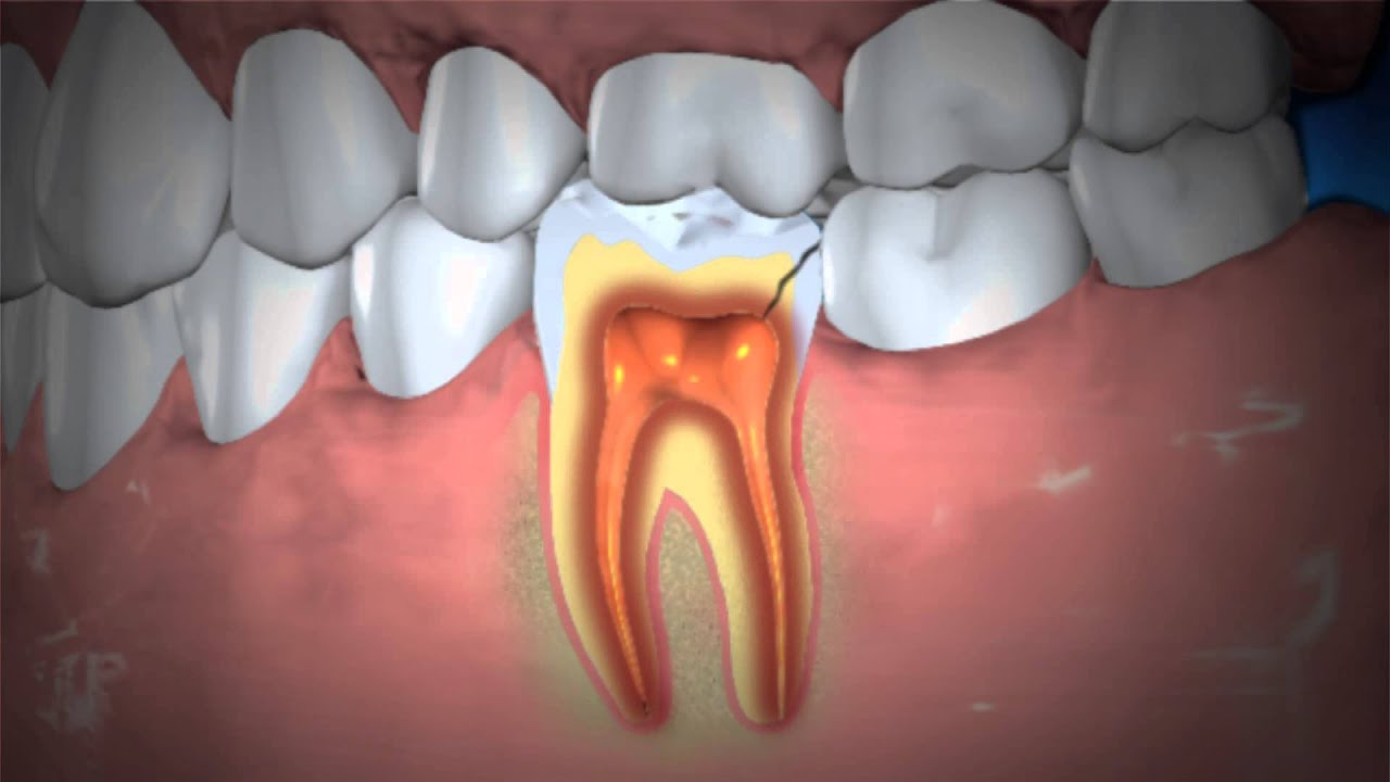 Treatment of Abscessed Teeth