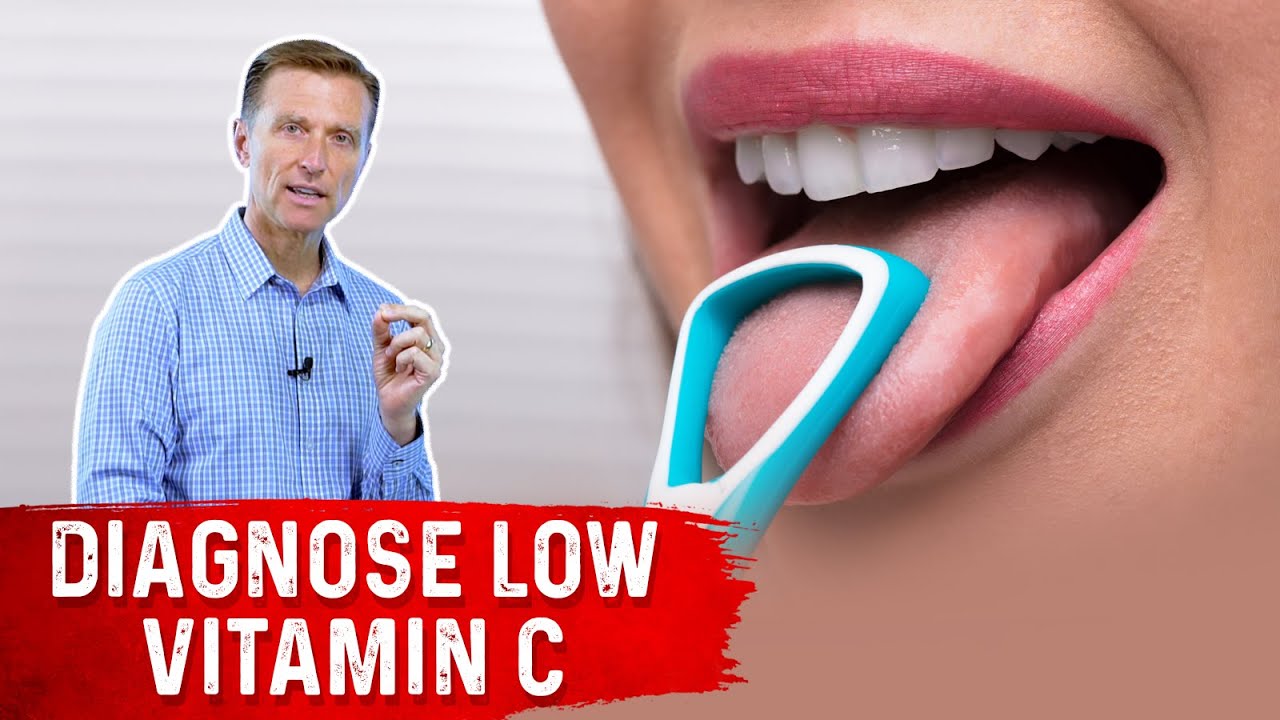 The Tongue Can Determine a Vitamin C Deficiency
